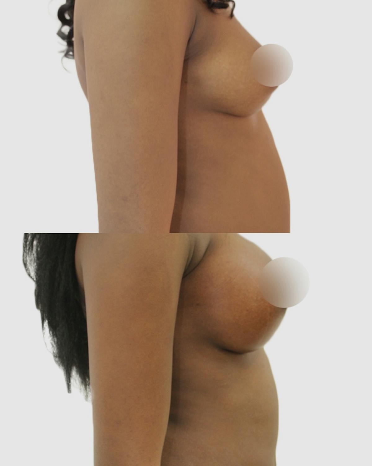 Breast Augmentation Before & After Gallery - Patient 218668 - Image 3