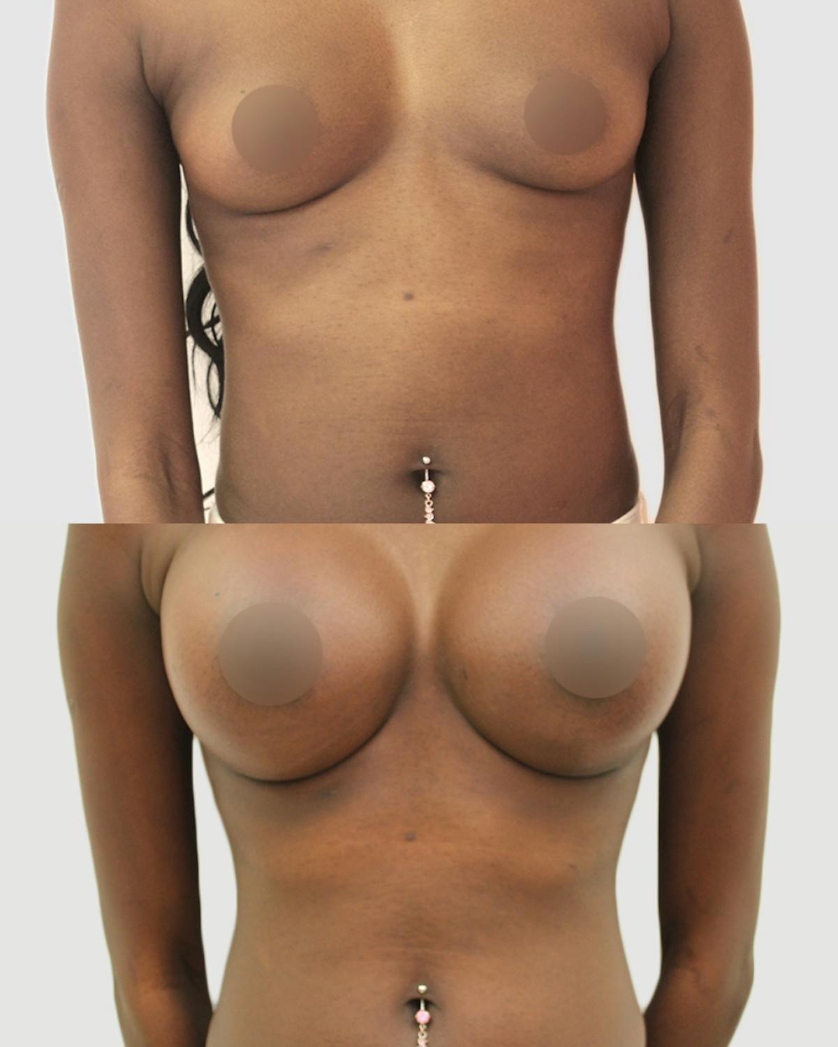 Breast Augmentation Before & After Gallery - Patient 288504 - Image 1