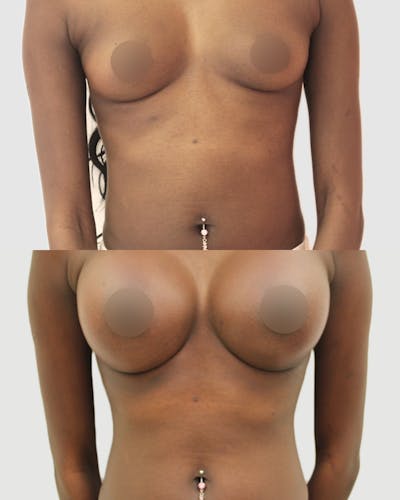 Breast Augmentation Before & After Gallery - Patient 288504 - Image 1