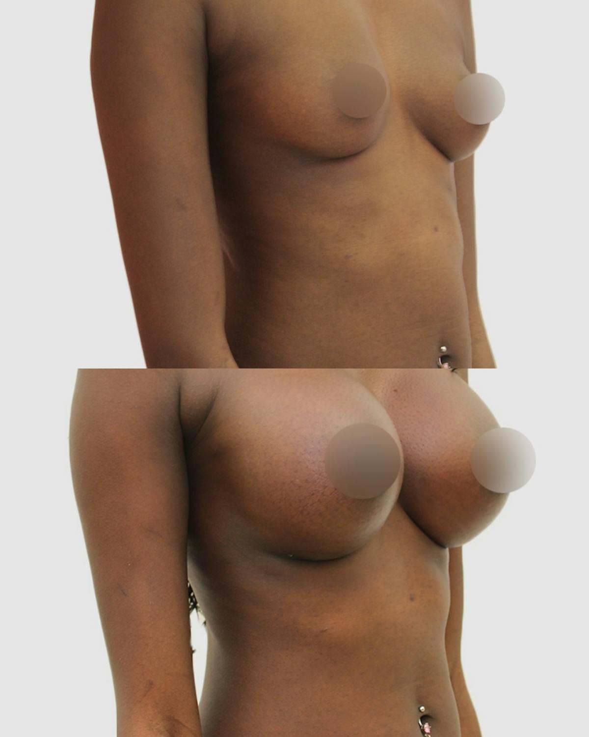 Breast Augmentation Before & After Gallery - Patient 288504 - Image 2