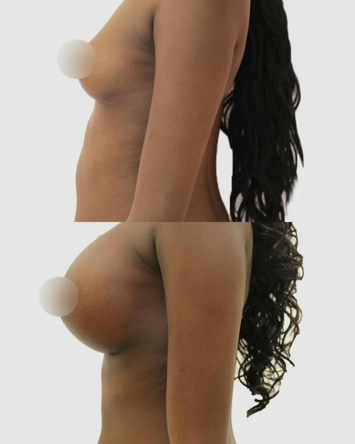 Breast Augmentation Before & After Gallery - Patient 288504 - Image 3