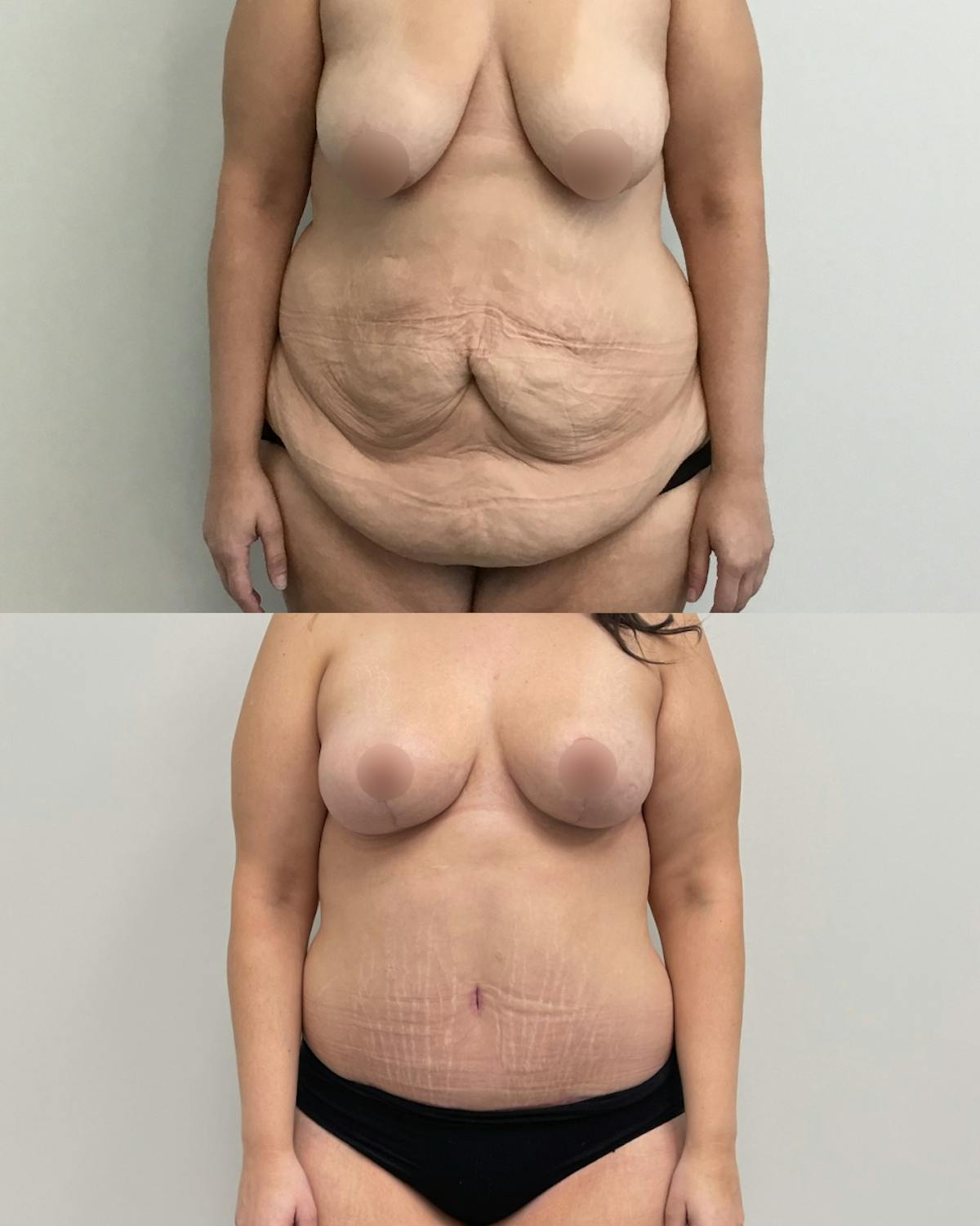 Mommy Makeover Before & After Gallery - Patient 200367 - Image 1
