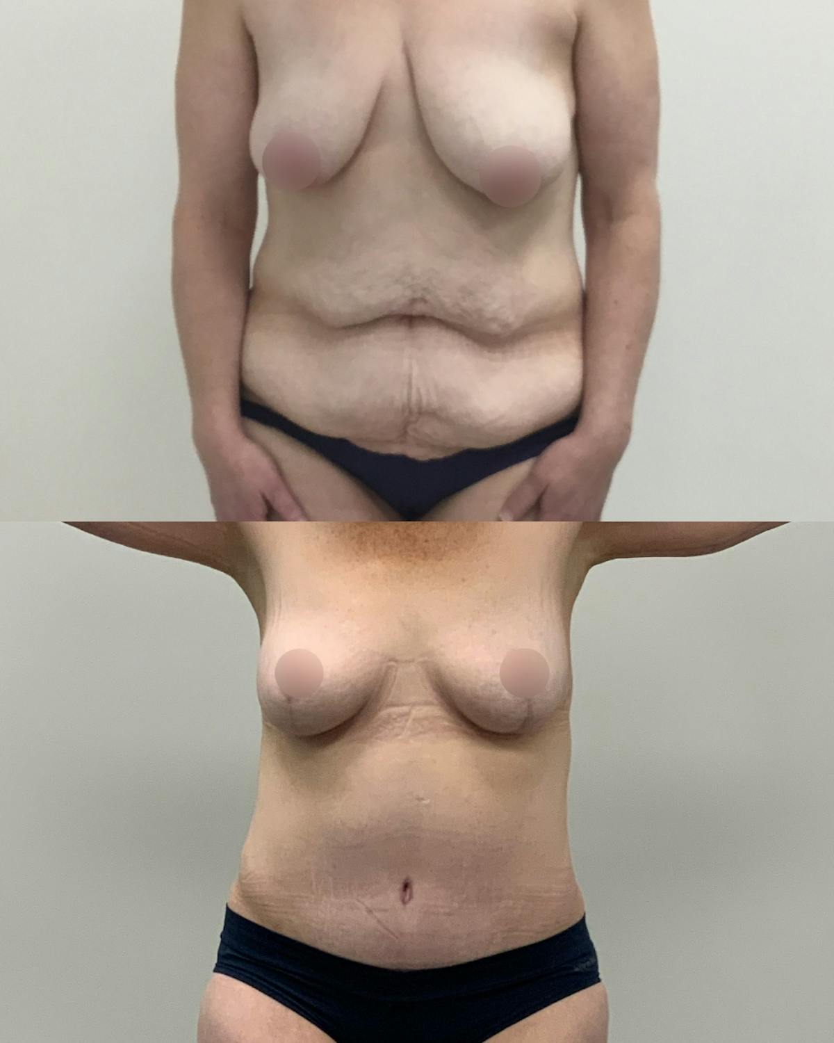 Mommy Makeover Before & After Gallery - Patient 220243 - Image 1