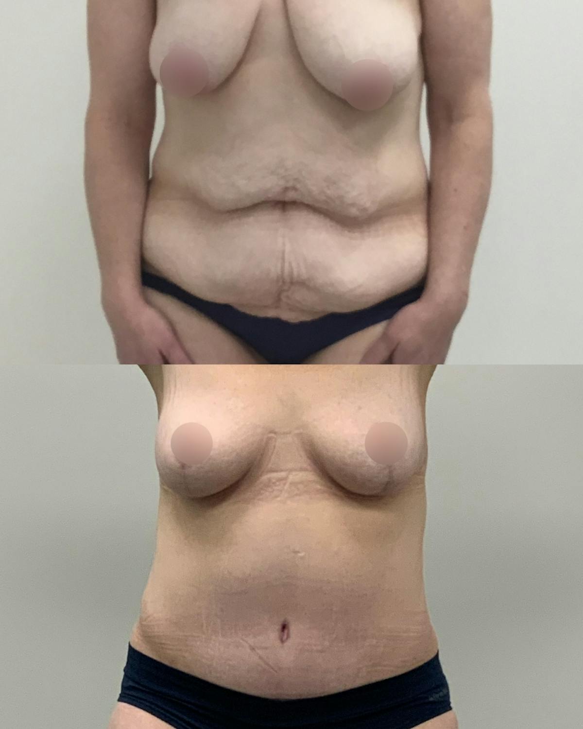 Tummy Tuck Before & After Gallery - Patient 401923 - Image 1