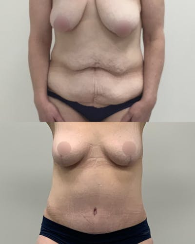 Tummy Tuck Before & After Gallery - Patient 401923 - Image 1