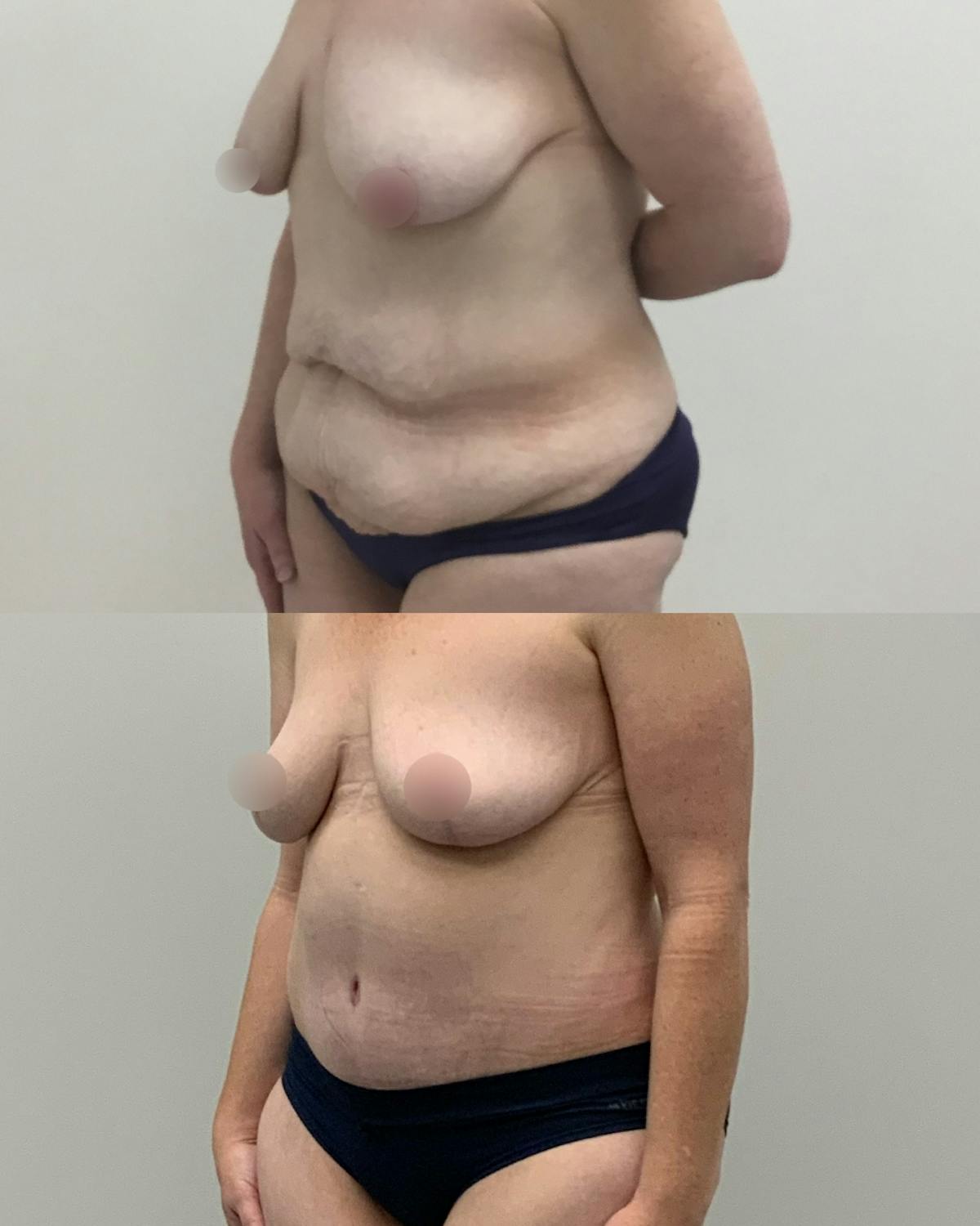 Tummy Tuck Before & After Gallery - Patient 401923 - Image 3