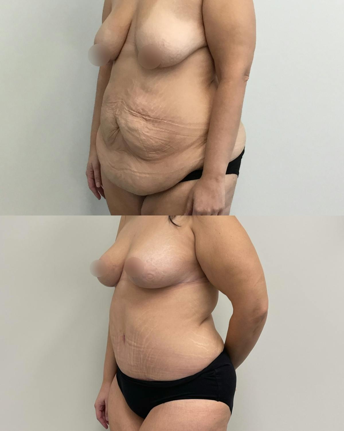 Mommy Makeover Before & After Gallery - Patient 200367 - Image 2