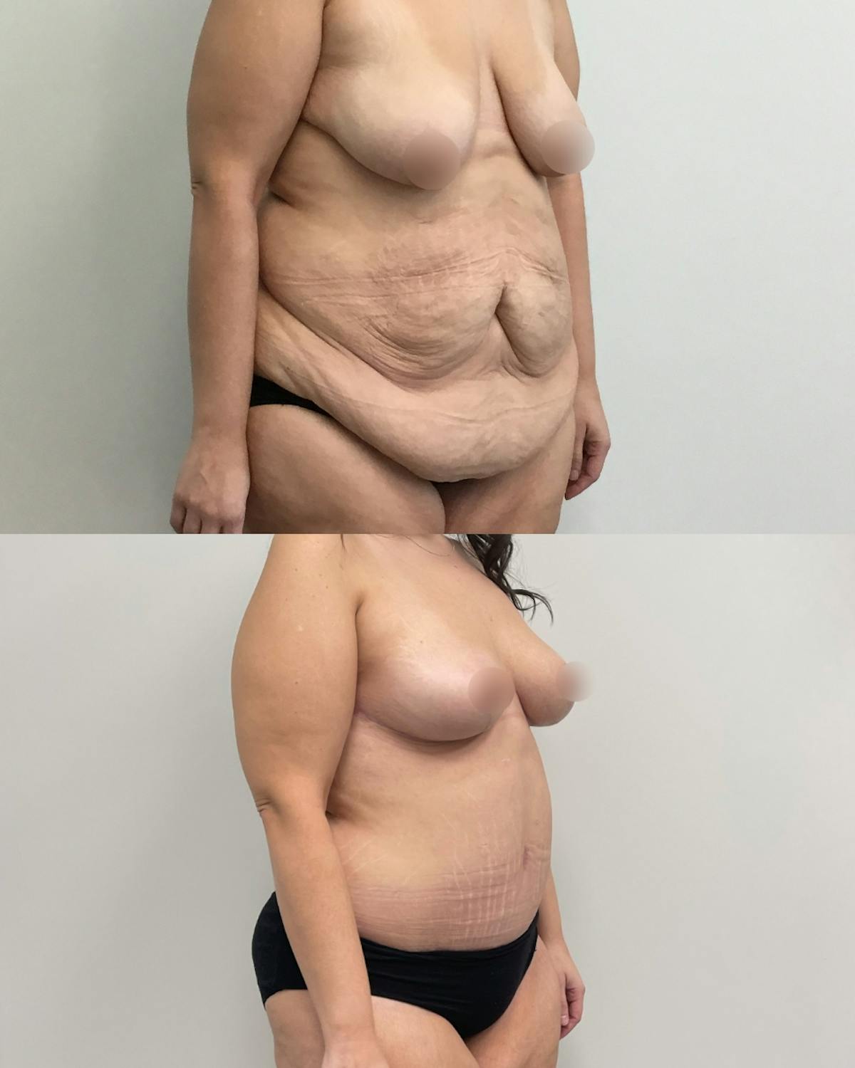 Mommy Makeover Before & After Gallery - Patient 200367 - Image 3