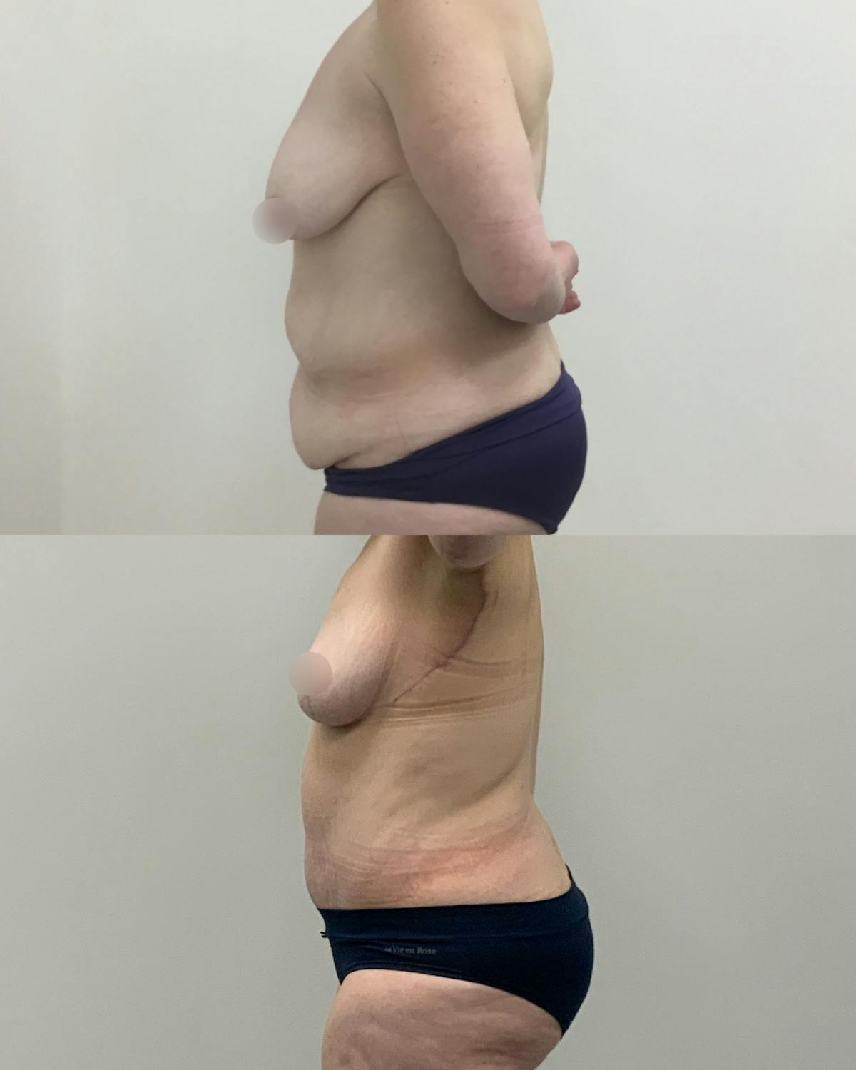 Mommy Makeover Before & After Gallery - Patient 220243 - Image 3