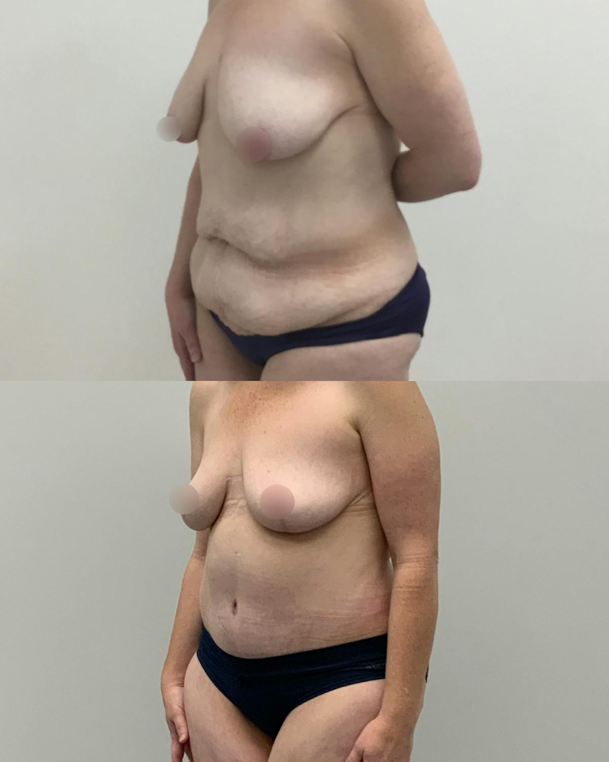 Mommy Makeover Before & After Gallery - Patient 220243 - Image 2