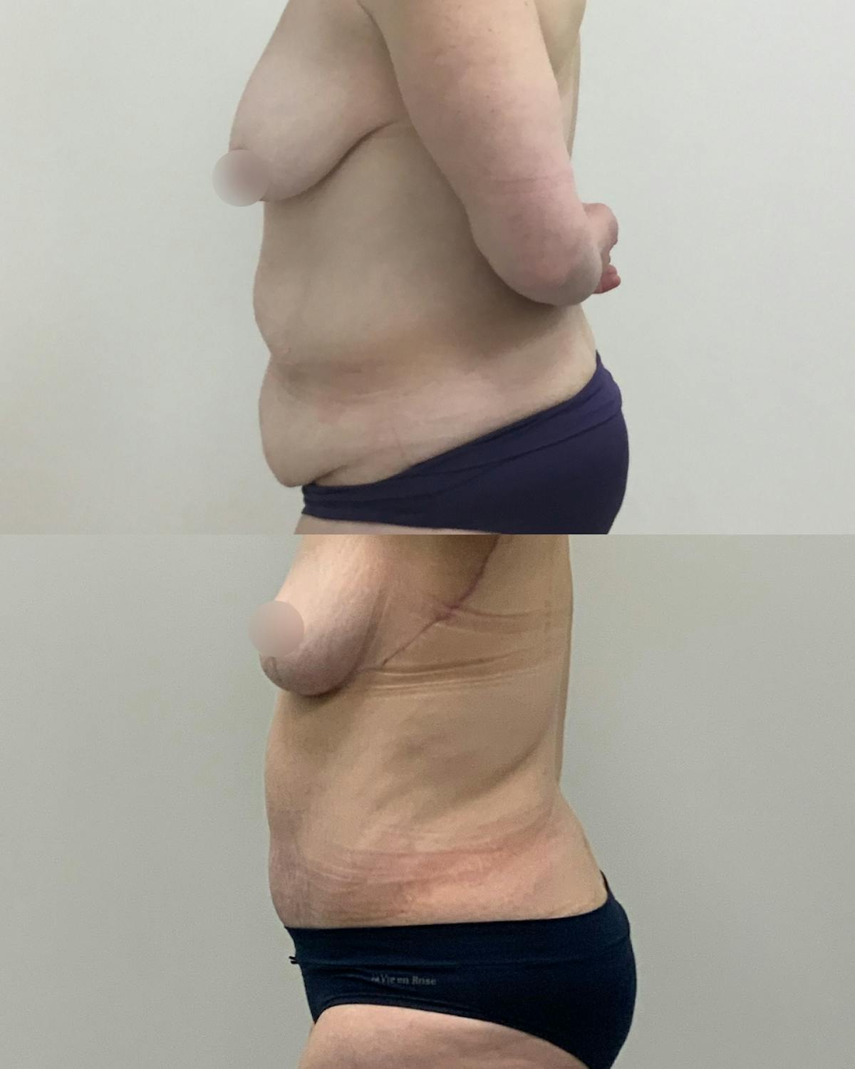 Tummy Tuck Before & After Gallery - Patient 401923 - Image 2