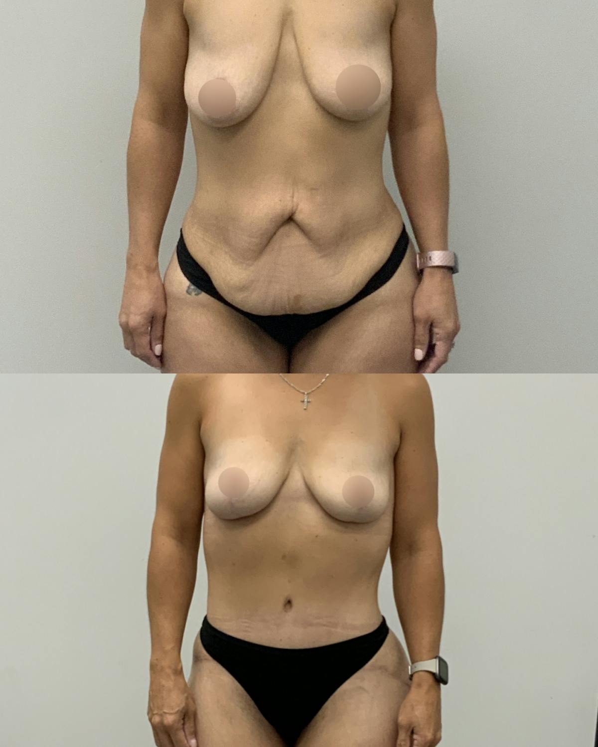 Mommy Makeover Before & After Gallery - Patient 325651 - Image 1