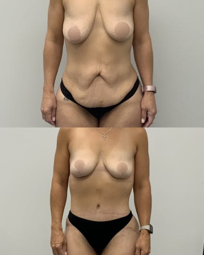 Mommy Makeover Before & After Gallery - Patient 325651 - Image 1