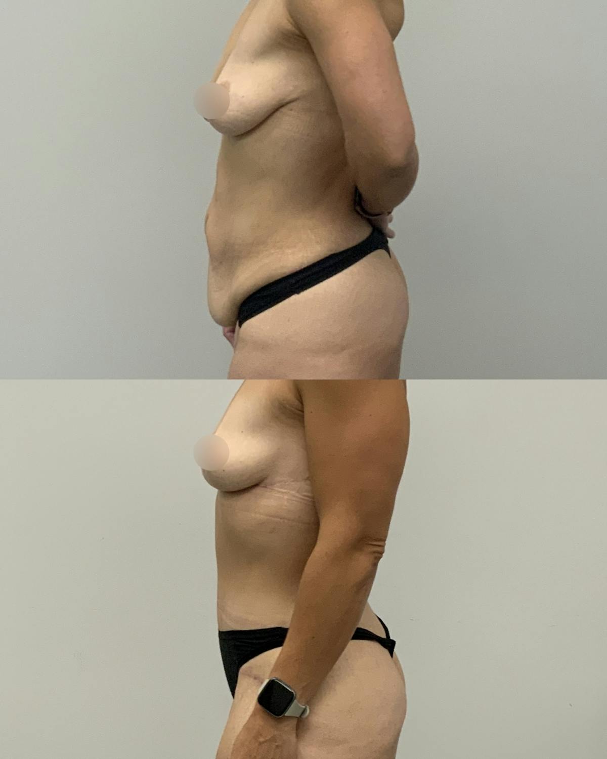 Mommy Makeover Before & After Gallery - Patient 325651 - Image 2