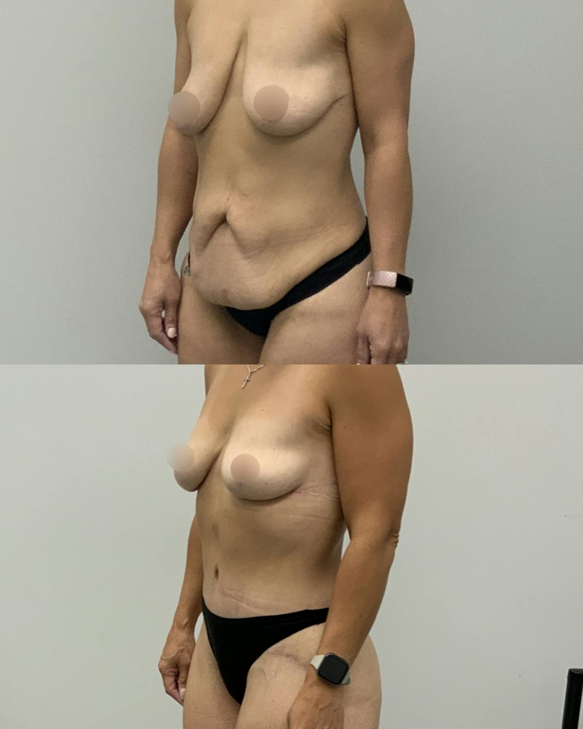 Mommy Makeover Before & After Gallery - Patient 325651 - Image 3