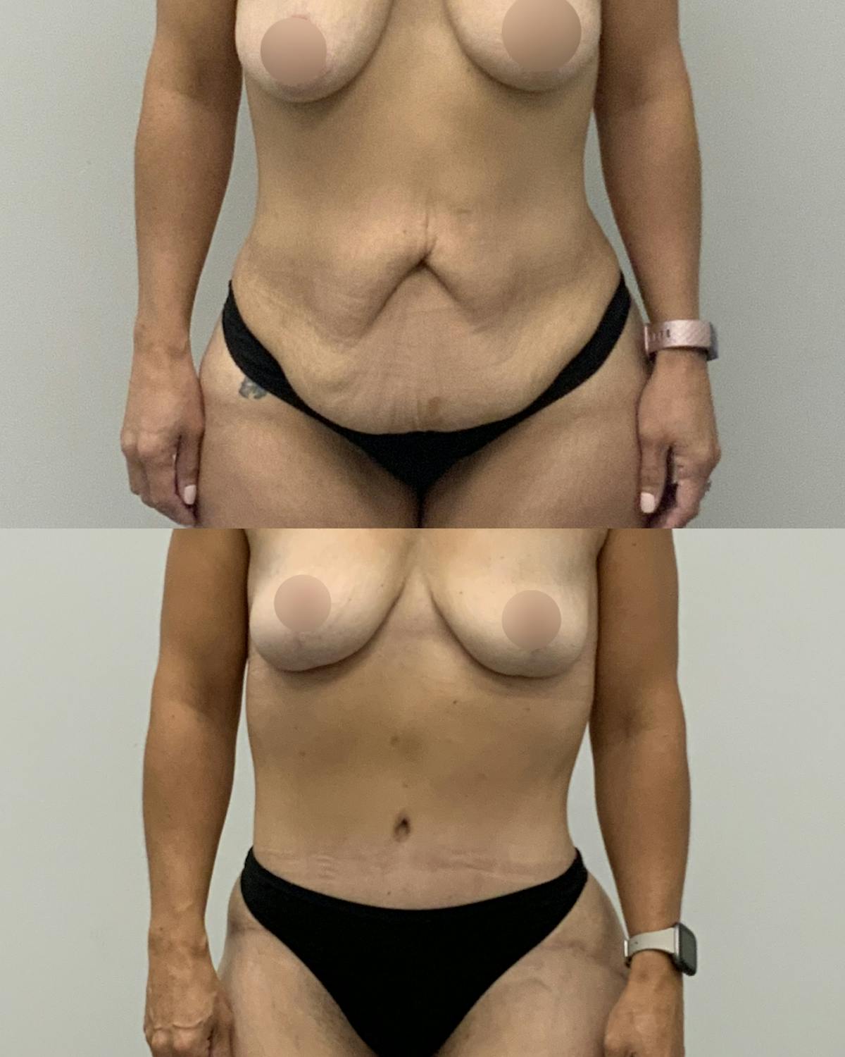 Tummy Tuck Before & After Gallery - Patient 212494 - Image 1