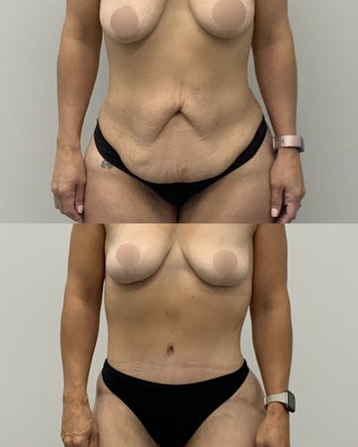 Tummy Tuck Before & After Gallery - Patient 212494 - Image 1
