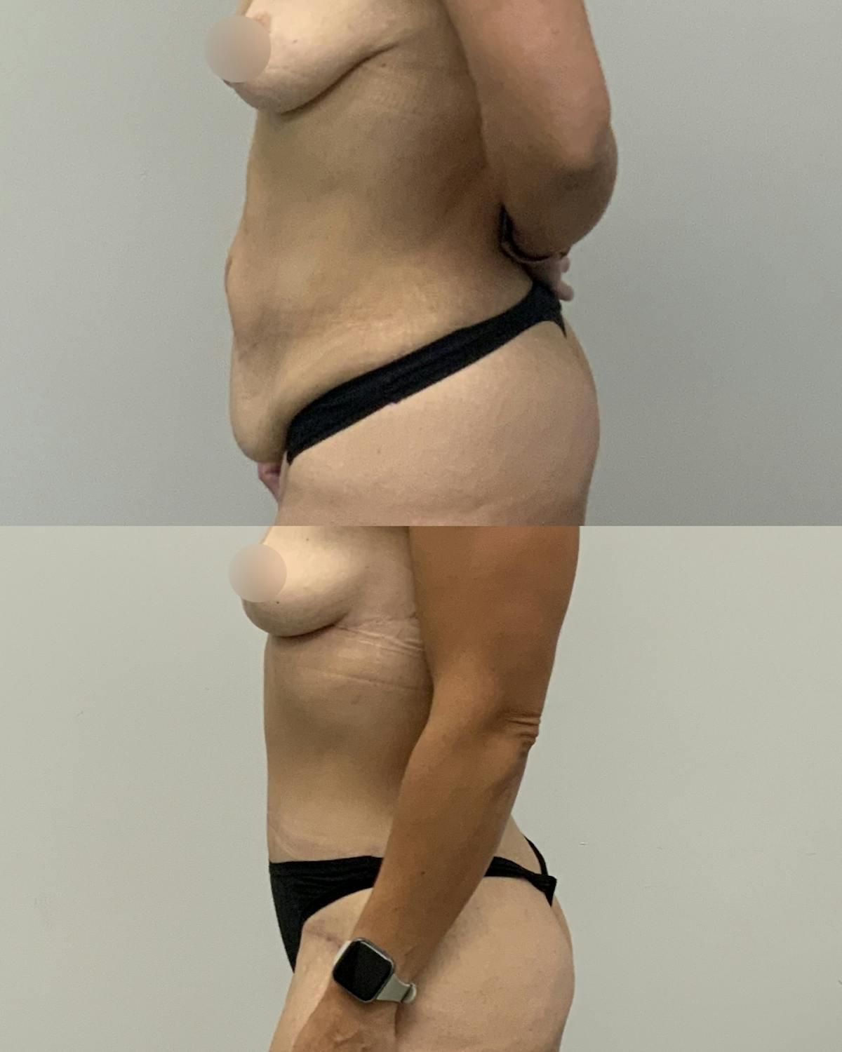 Tummy Tuck Before & After Gallery - Patient 212494 - Image 2