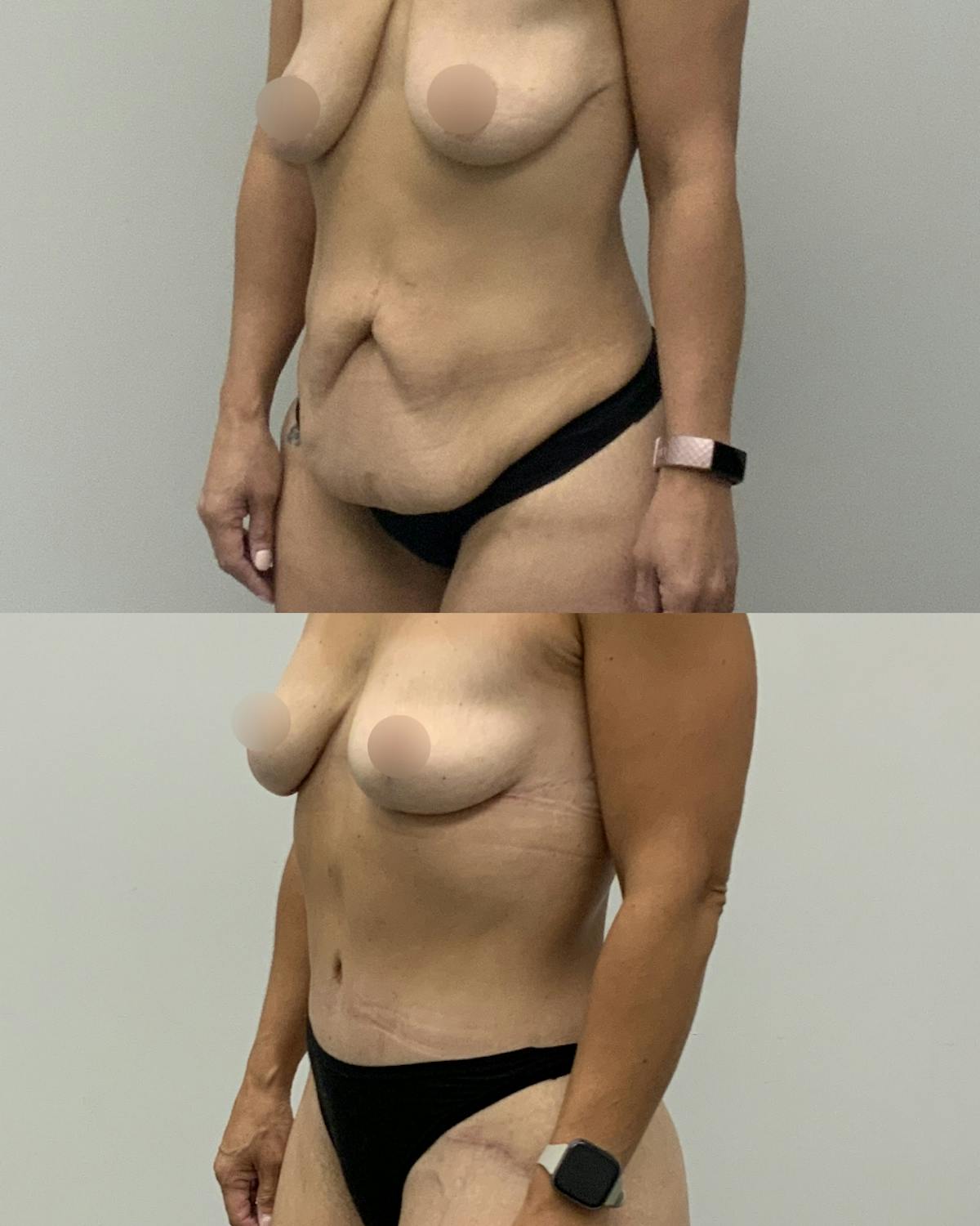 Tummy Tuck Before & After Gallery - Patient 212494 - Image 3