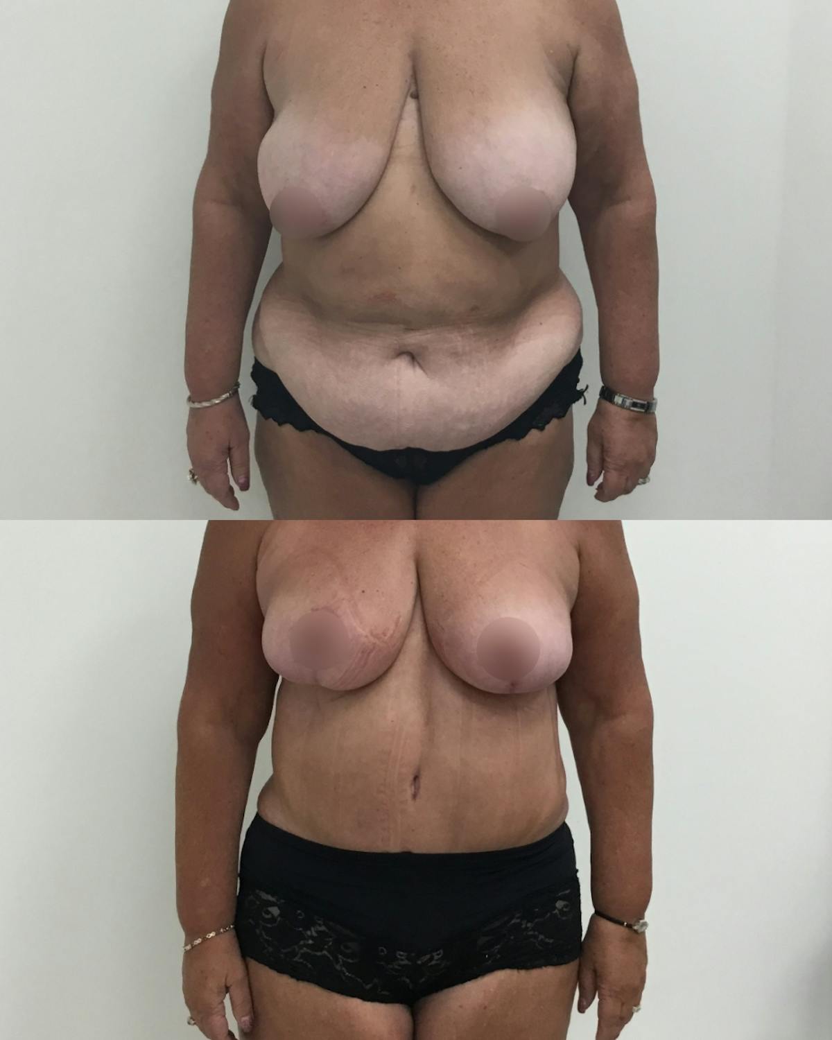 Mommy Makeover Before & After Gallery - Patient 148214 - Image 1