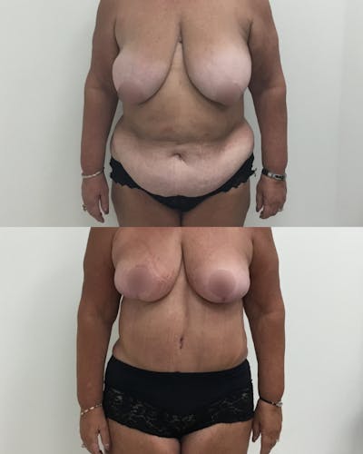 Mommy Makeover Before & After Gallery - Patient 148214 - Image 1