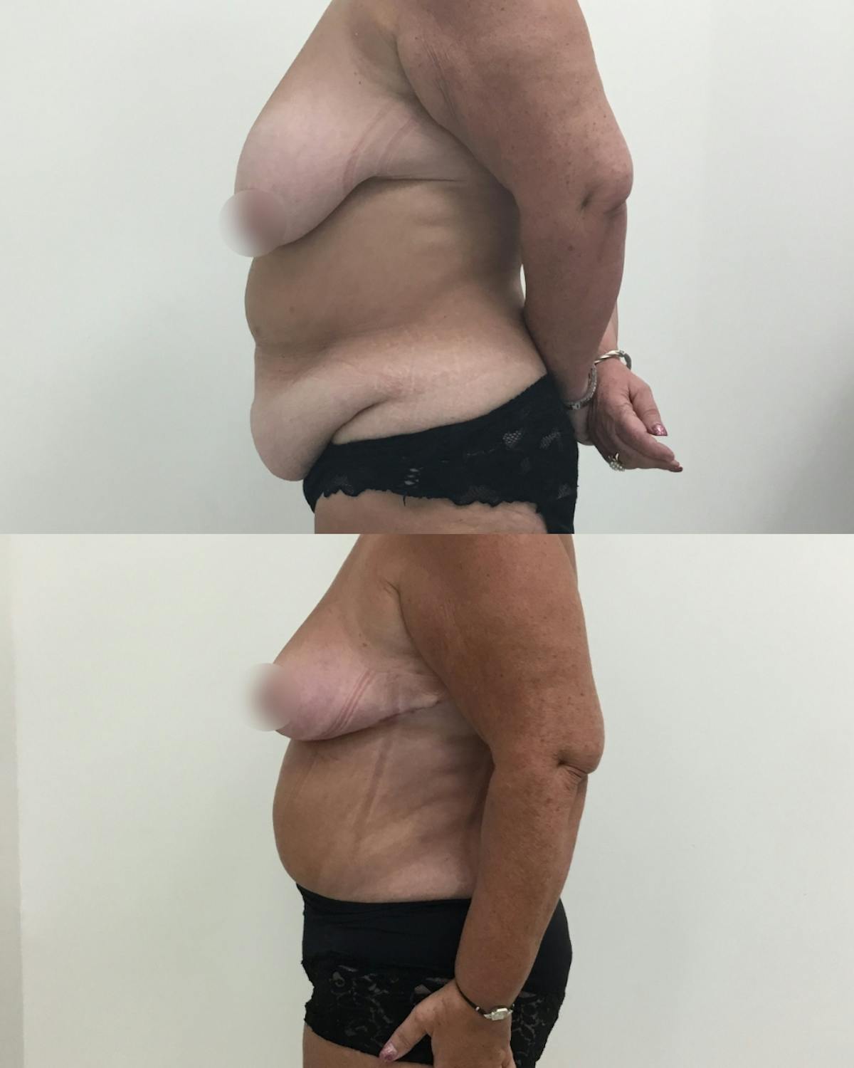 Mommy Makeover Before & After Gallery - Patient 148214 - Image 3