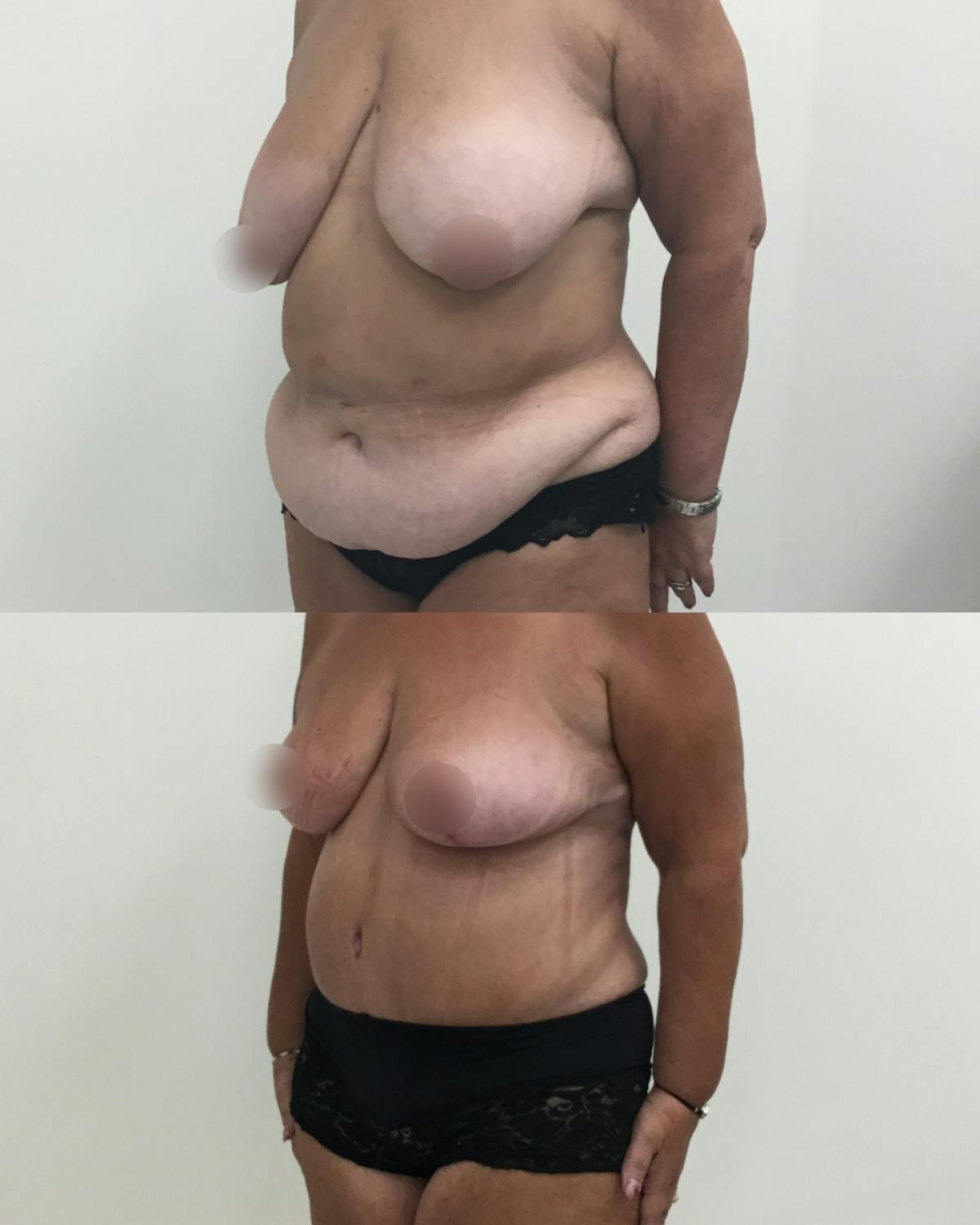 Mommy Makeover Before & After Gallery - Patient 148214 - Image 2