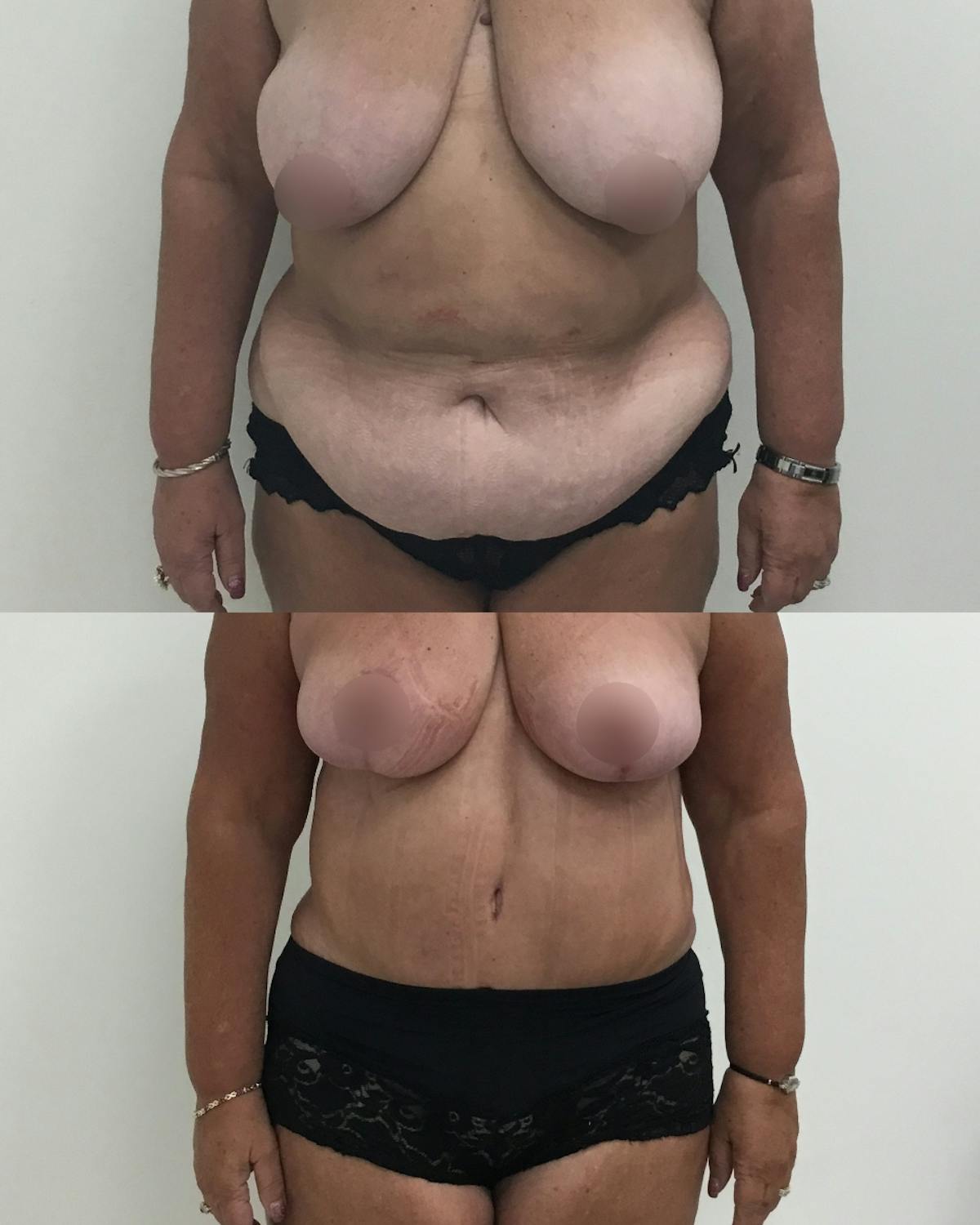 Tummy Tuck Before & After Gallery - Patient 291777 - Image 1