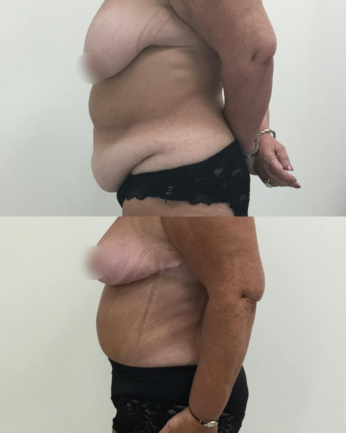 Tummy Tuck Before & After Gallery - Patient 291777 - Image 3