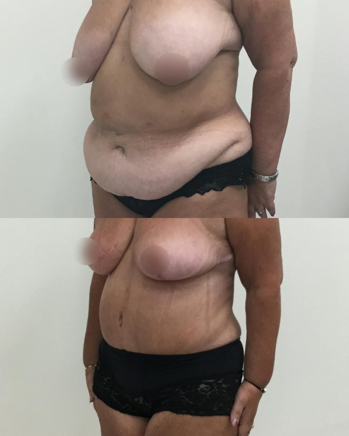 Tummy Tuck Before & After Gallery - Patient 291777 - Image 2