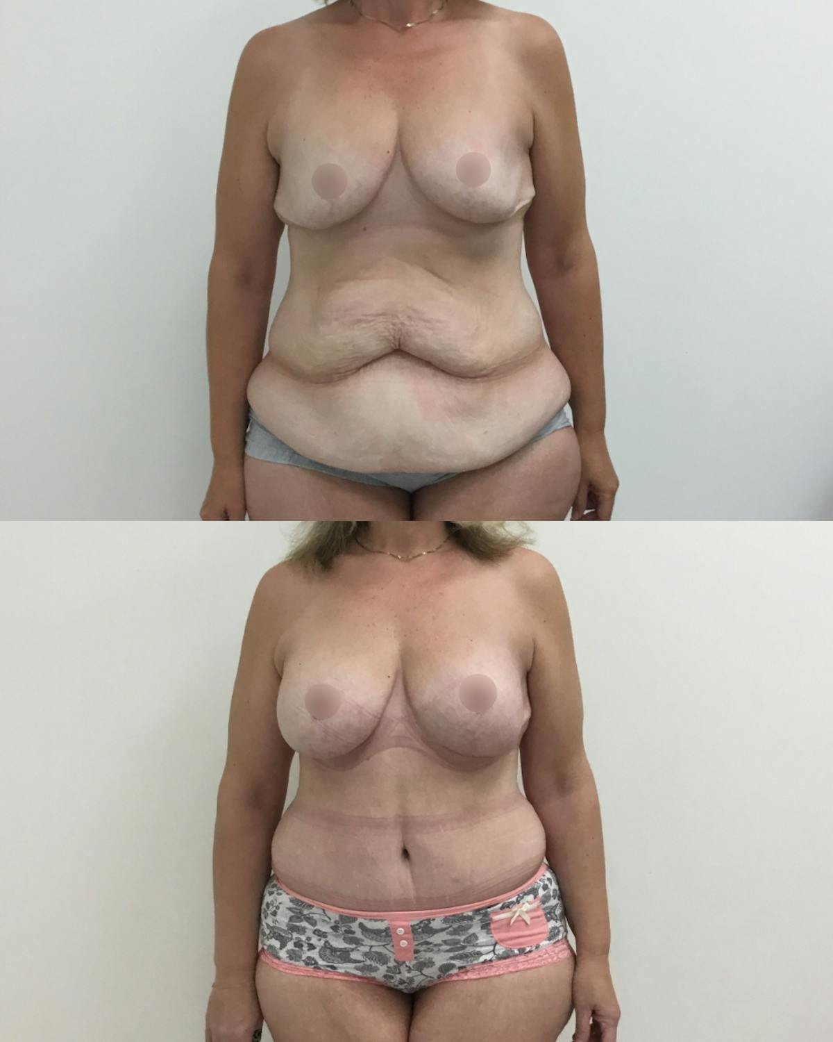 Mommy Makeover Before & After Gallery - Patient 339161 - Image 1