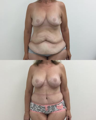 Mommy Makeover Before & After Gallery - Patient 339161 - Image 1
