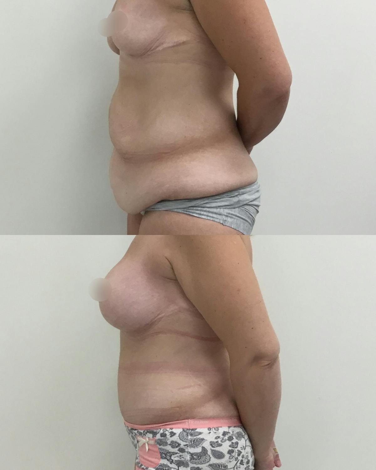 Tummy Tuck Before & After Gallery - Patient 368088 - Image 3