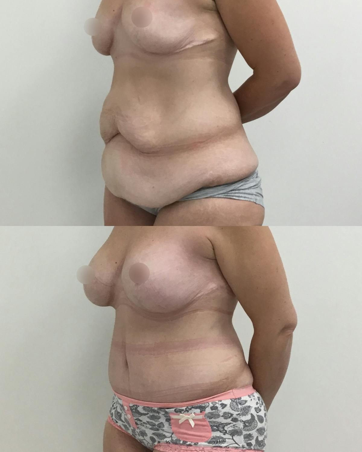Tummy Tuck Before & After Gallery - Patient 368088 - Image 2