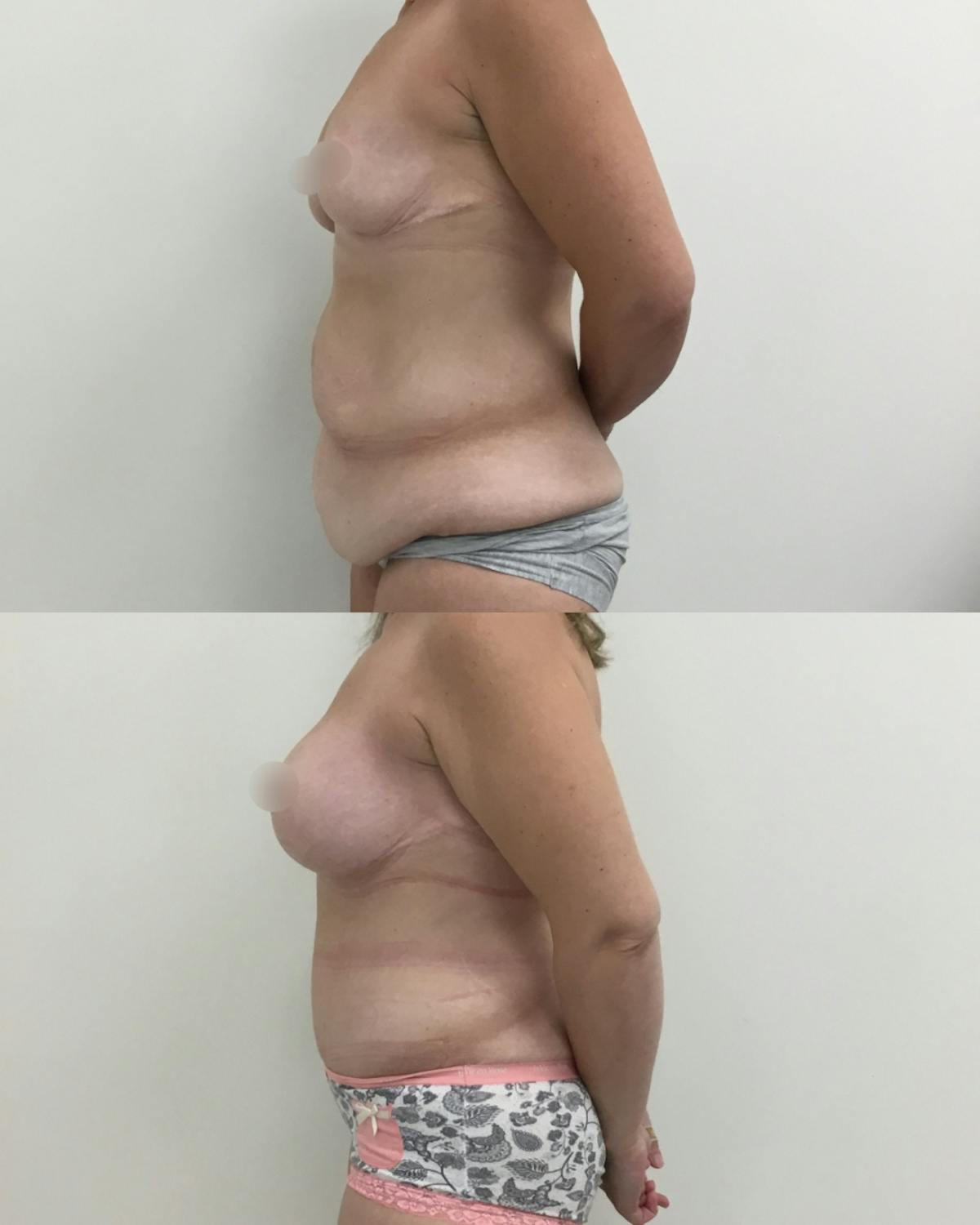 Mommy Makeover Before & After Gallery - Patient 339161 - Image 3