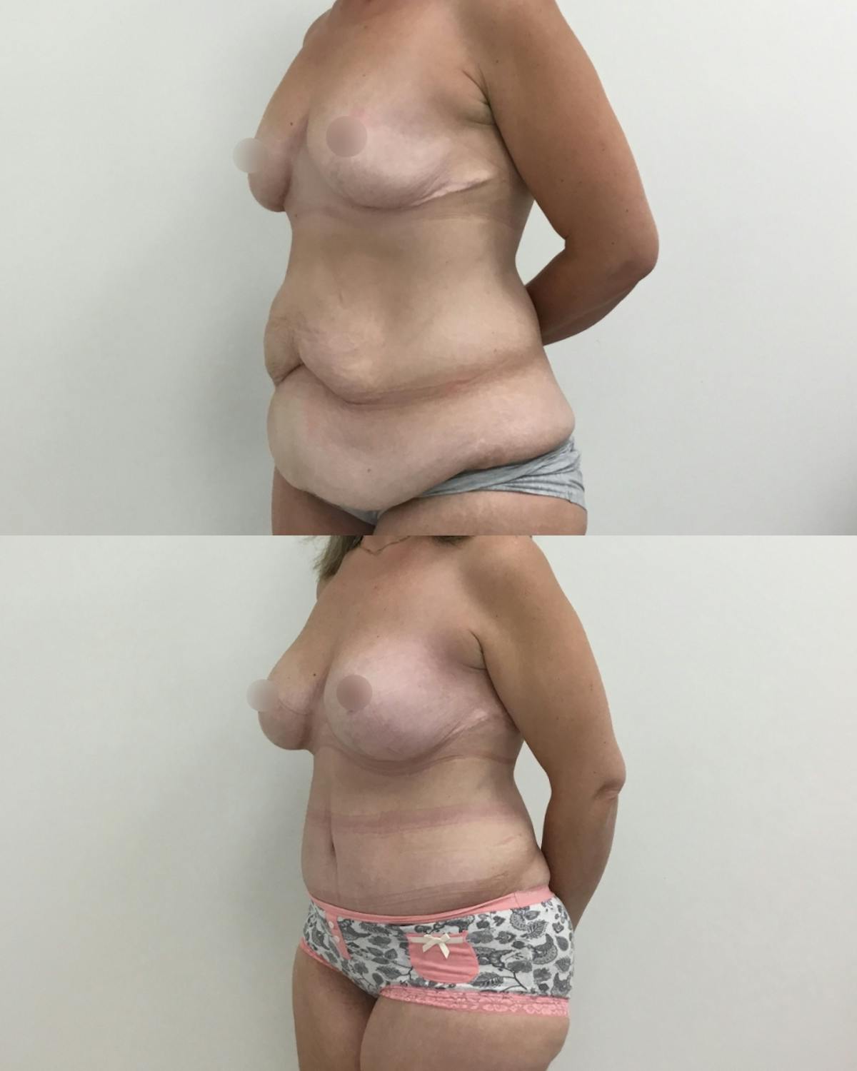 Mommy Makeover Before & After Gallery - Patient 339161 - Image 2