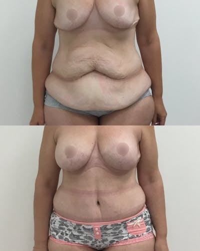 Tummy Tuck Before & After Gallery - Patient 368088 - Image 1
