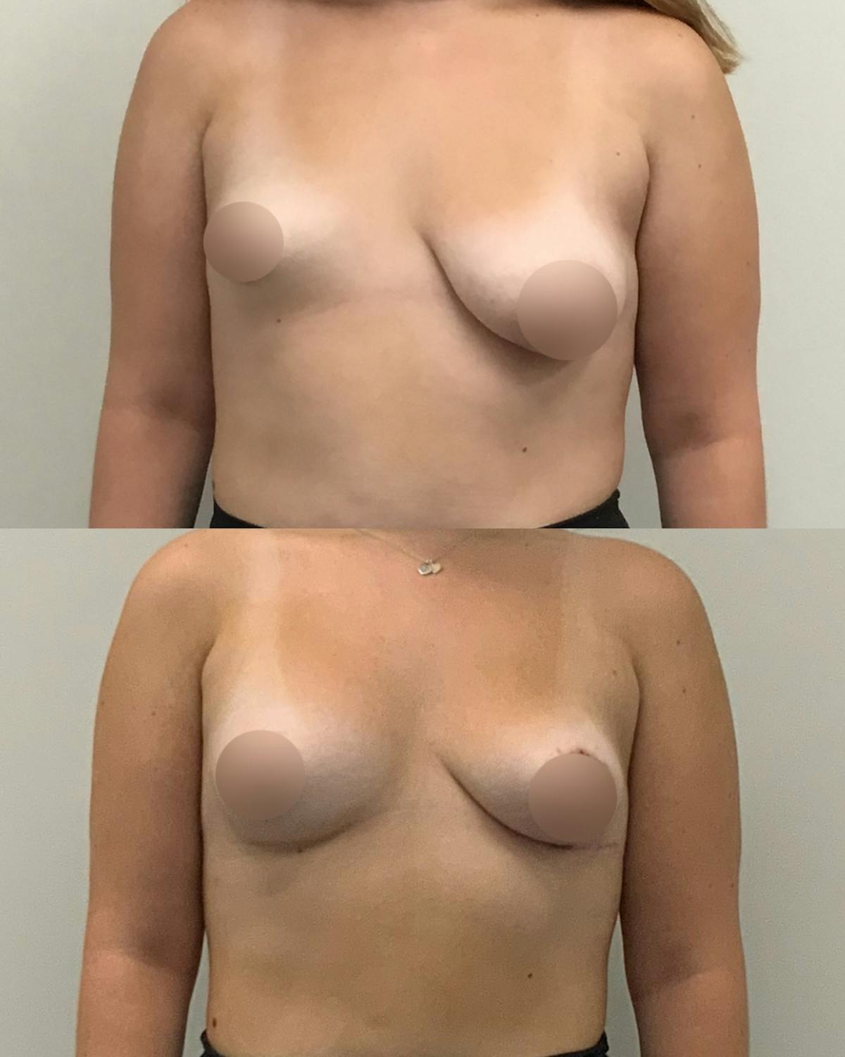 Breast Asymmetry Correction Before & After Gallery - Patient 301904 - Image 1