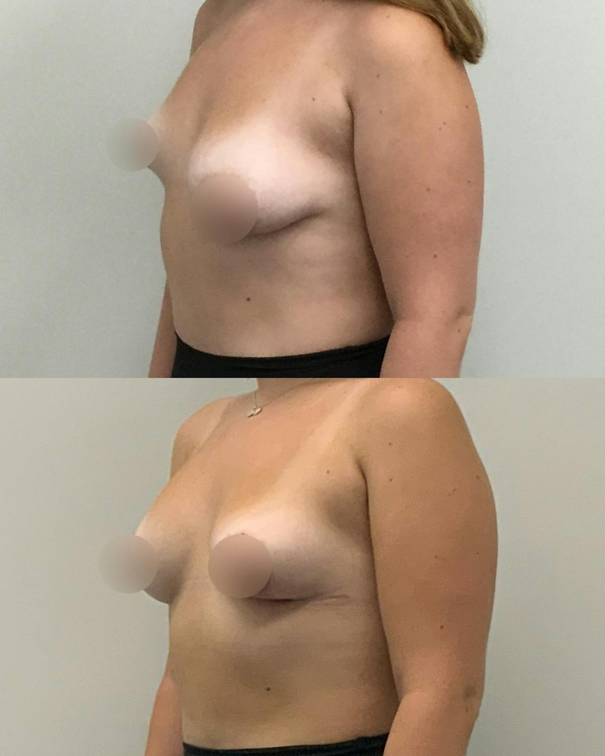 Breast Asymmetry Correction Before & After Gallery - Patient 301904 - Image 2