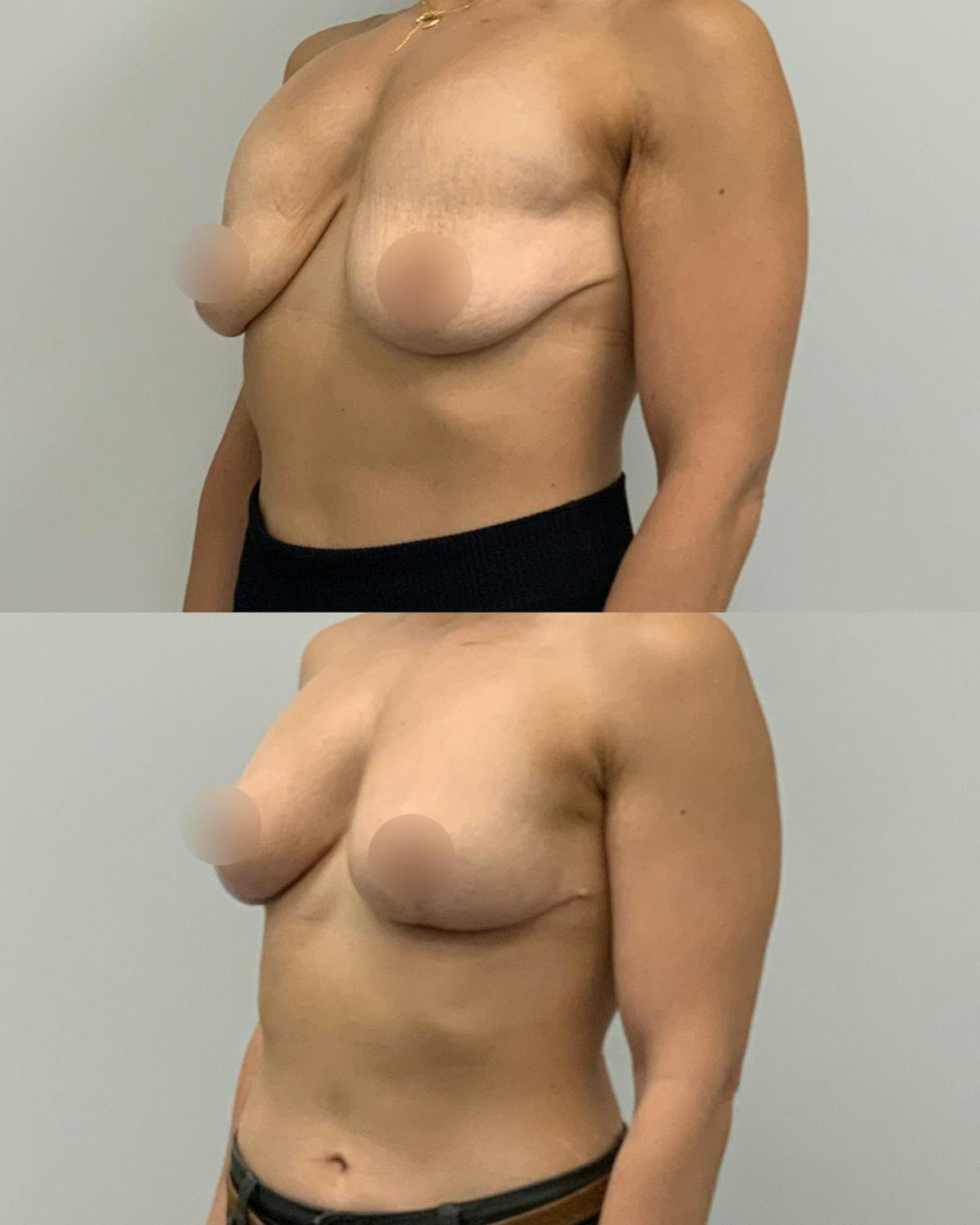 Breast Asymmetry Correction Before & After Gallery - Patient 301904 - Image 2