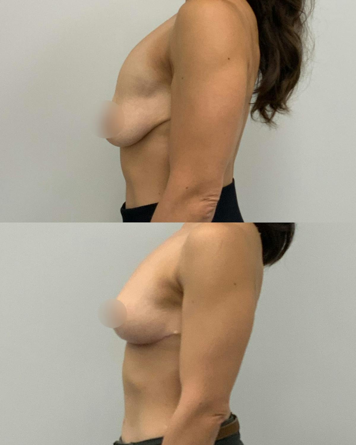 Breast Asymmetry Correction Before & After Gallery - Patient 910251 - Image 3
