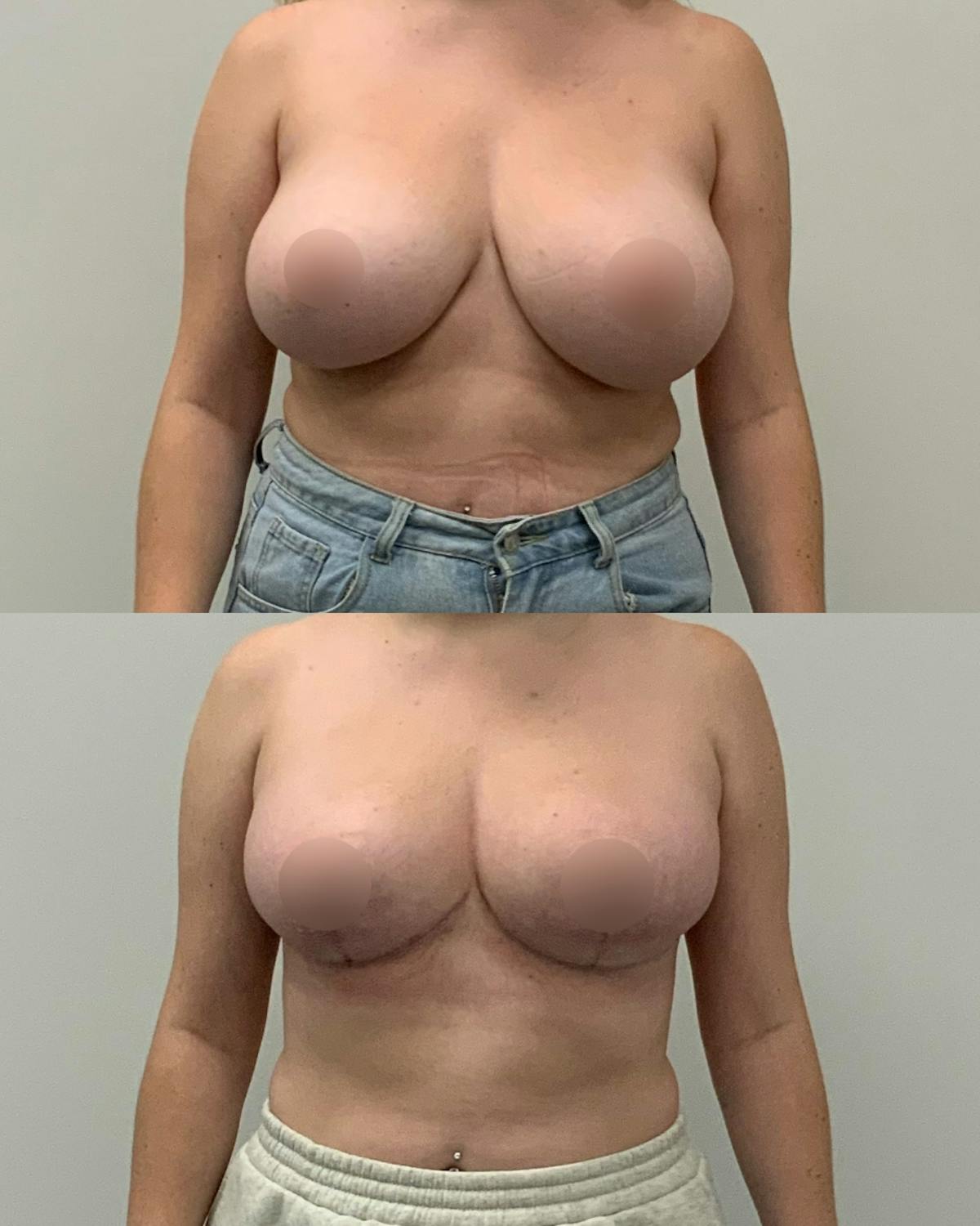 Breast Asymmetry Correction Before & After Gallery - Patient 277276 - Image 1