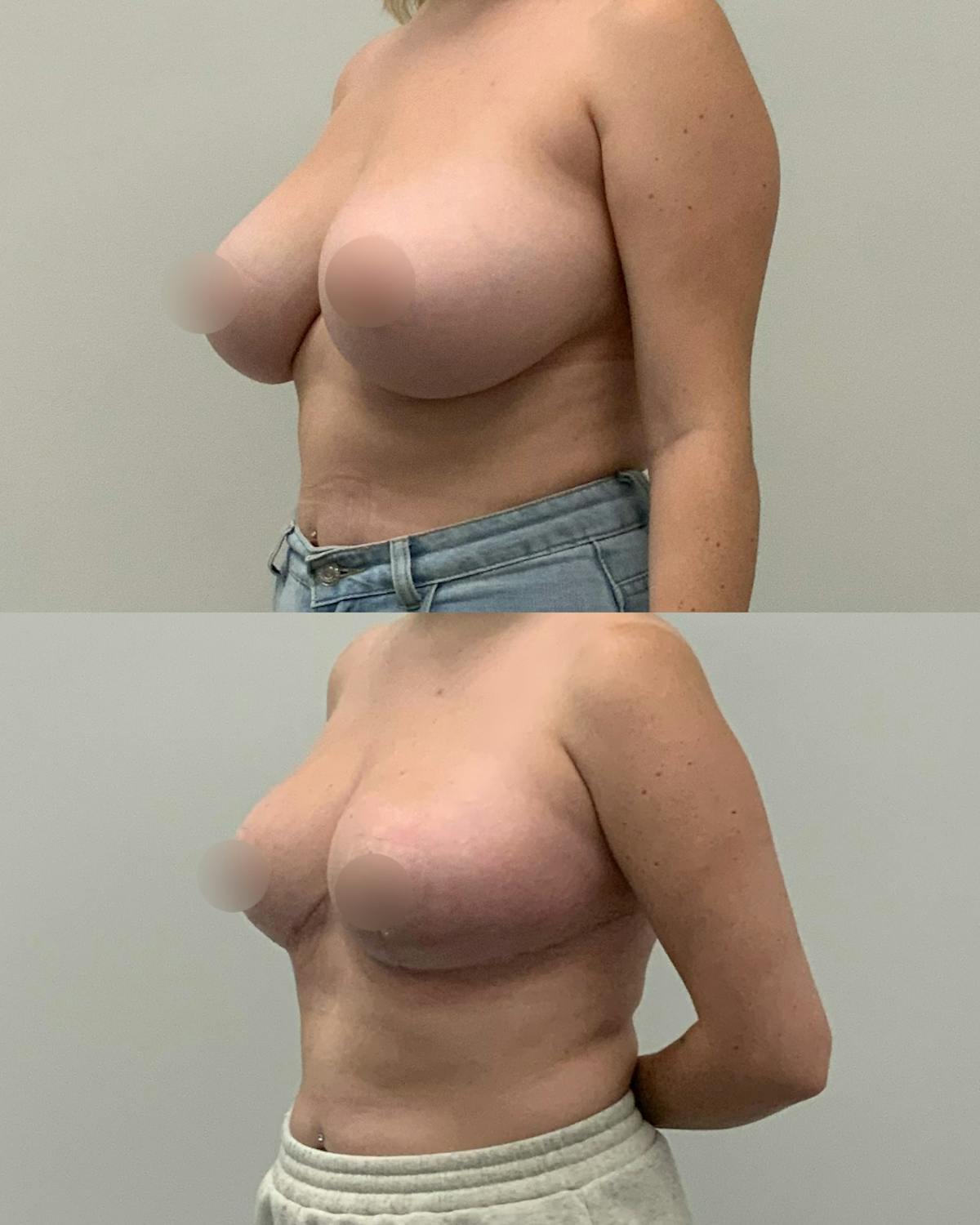 Breast Asymmetry Correction Before & After Gallery - Patient 277276 - Image 2