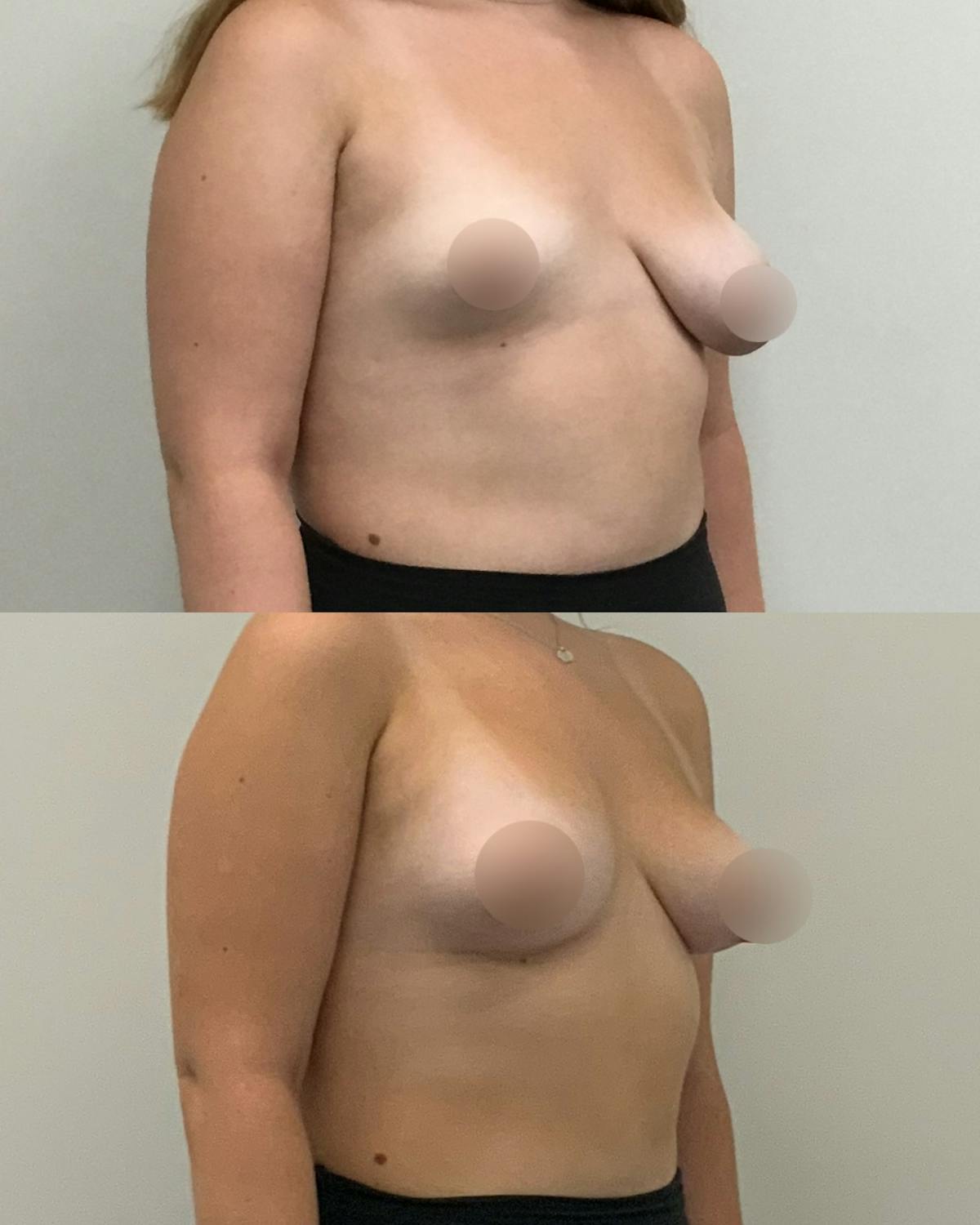 Breast Asymmetry Correction Before & After Gallery - Patient 301904 - Image 3