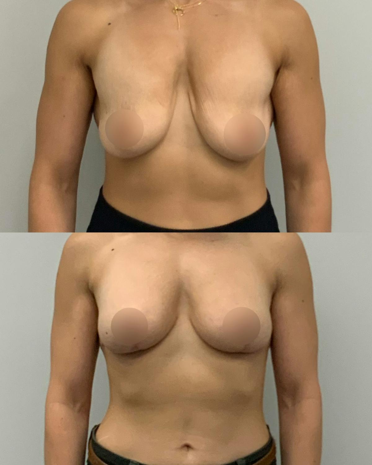 Breast Asymmetry Correction Before & After Gallery - Patient 910251 - Image 1