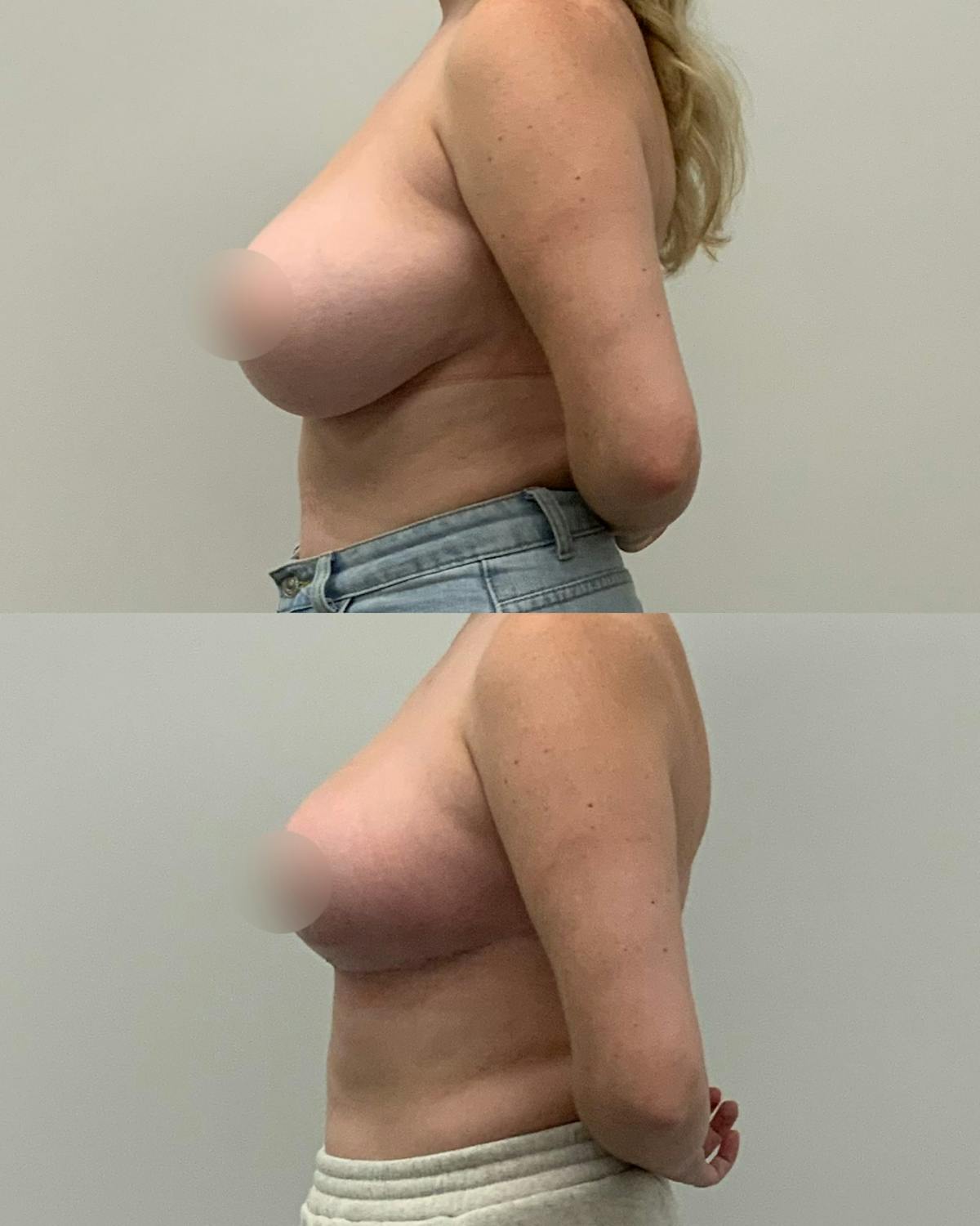 Breast Asymmetry Correction Before & After Gallery - Patient 277276 - Image 3