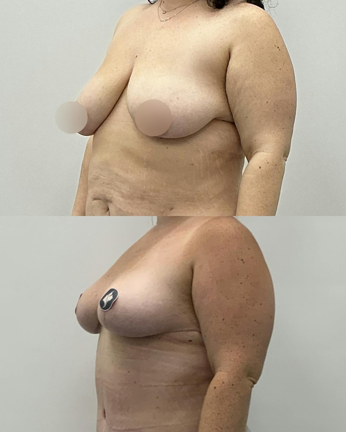 Breast Lift Before & After Gallery - Patient 303095 - Image 2