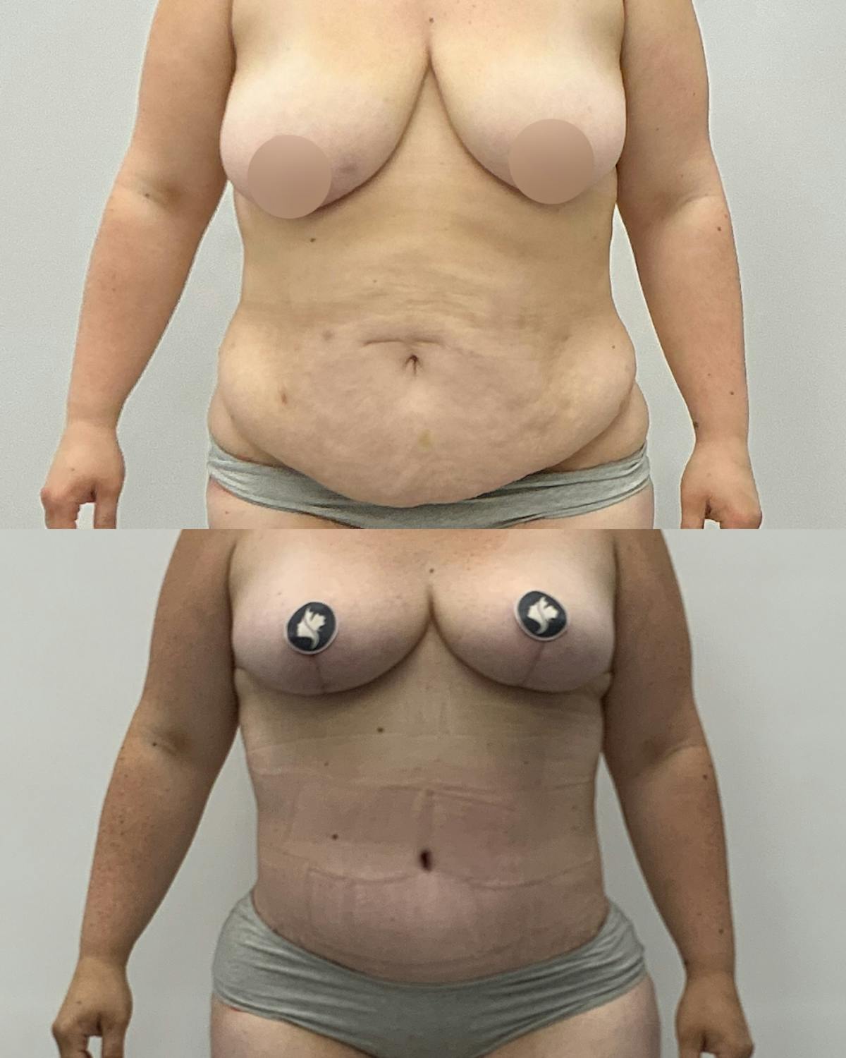 Tummy Tuck Before & After Gallery - Patient 461396 - Image 1