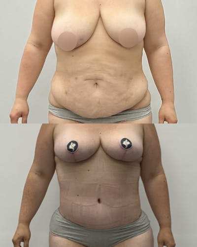 Tummy Tuck Before & After Gallery - Patient 461396 - Image 1