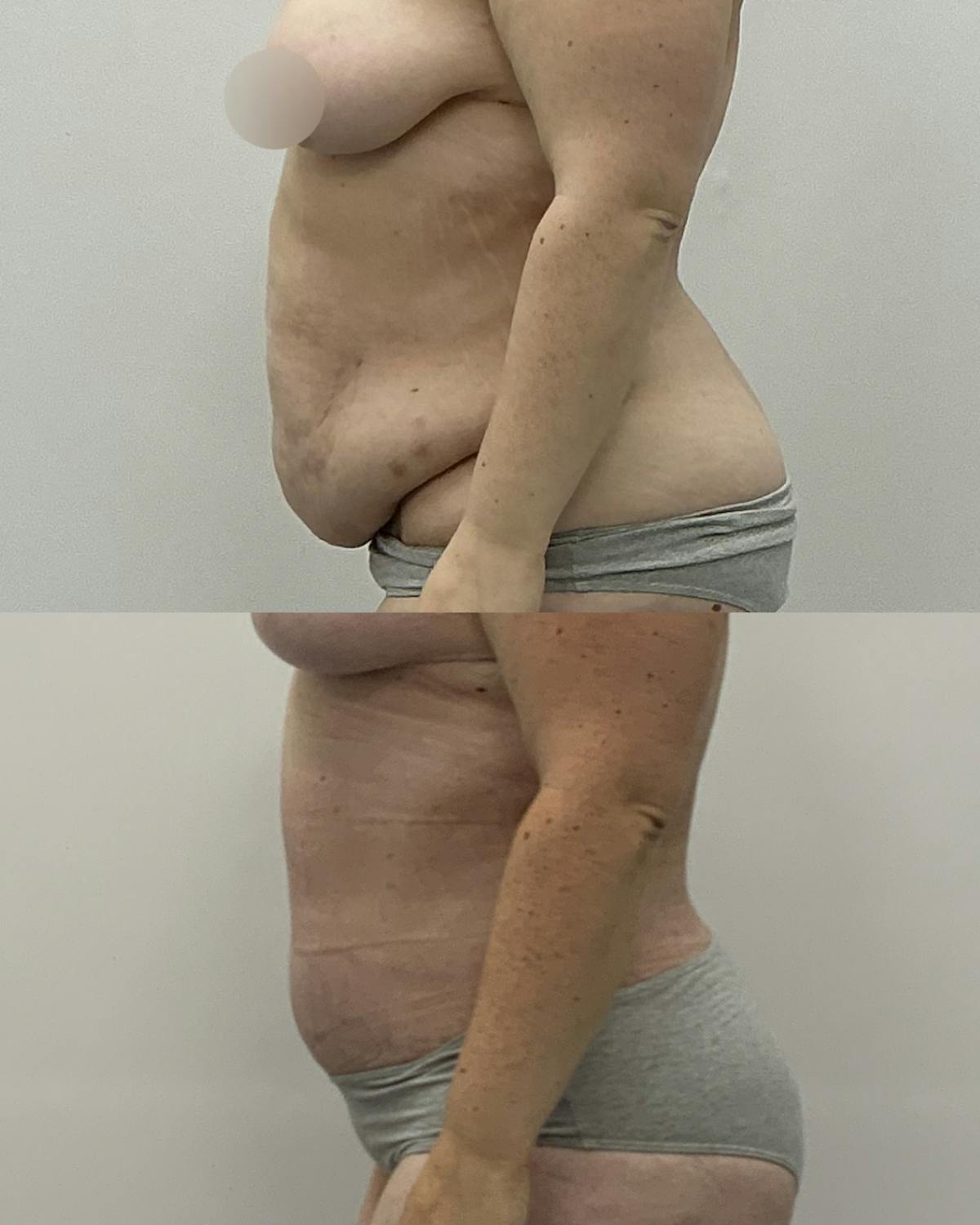 Tummy Tuck Before & After Gallery - Patient 461396 - Image 3